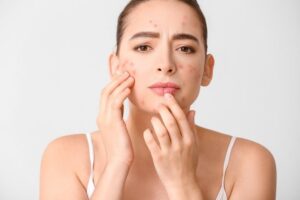 A Guide to Dermatology for Teens: Managing Acne and More