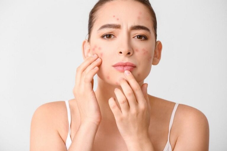 A Guide to Dermatology for Teens: Managing Acne and More
